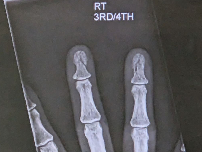 X-ray image of two fractured fingertips